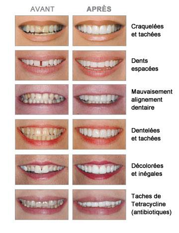 Esthétique dentaire à paris 16 - Traitement par facettes dentaires