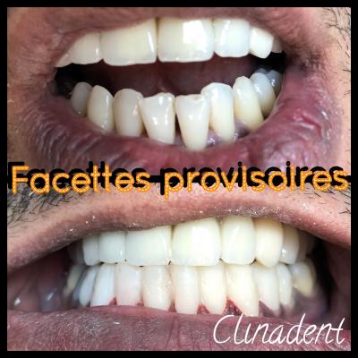 Facettes dentaires au Centre Clinadent à Paris 16