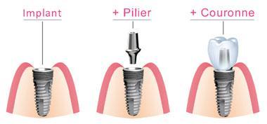 Composants implant dentaire Paris 16 